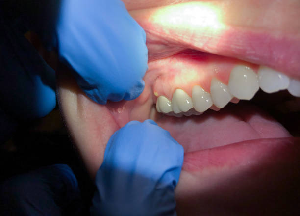 Best Dentist for Tooth Abscess  in Parklawn, CA